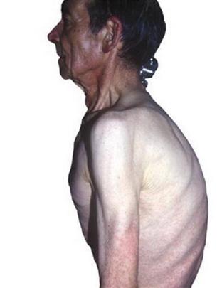 Picture 2 of Chronic obstructive pulmonary disease: Difficulty breathing but not hopeless!