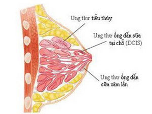 Picture 1 of Cleansing products increase the risk of breast cancer