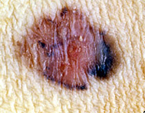 Picture 1 of Cloning immune cells to treat cancer