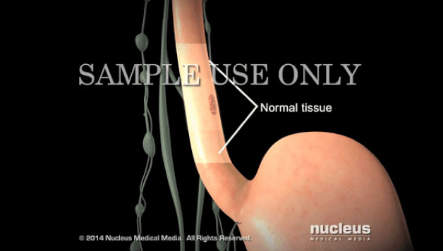 Picture 4 of Close-up of the formation of this type of cancer stems from the habit of eating Vietnamese people often