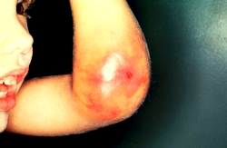 Picture 4 of Coagulation disorders: The disease must live on someone else's blood