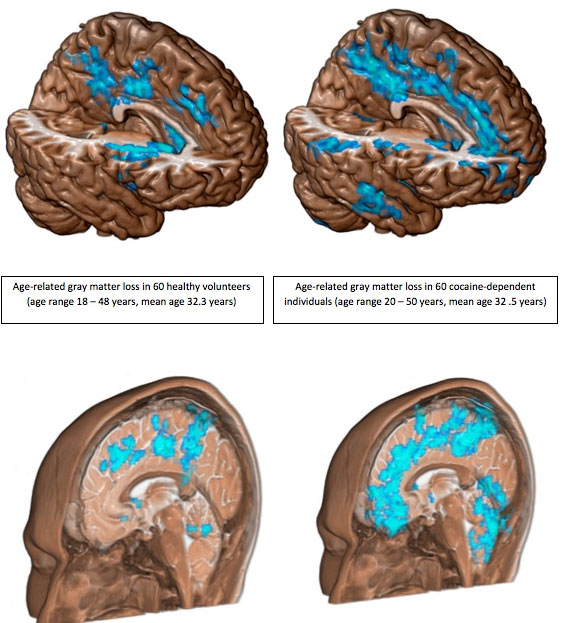 Picture 1 of Cocaine wreaks havoc on the brain
