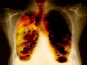Picture 1 of Coming soon, new drugs thoroughly attack cancer