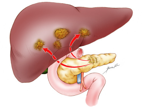 Picture 6 of Common cancers in men
