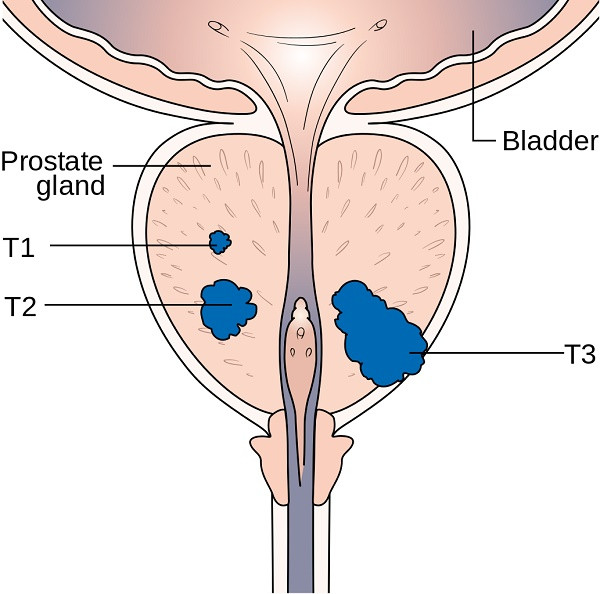 Picture 7 of Common cancers in men