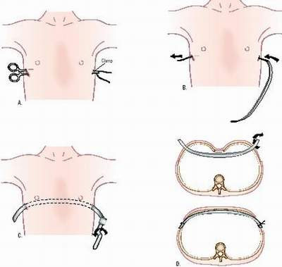 Picture 1 of Congenital chest concave and health consequences