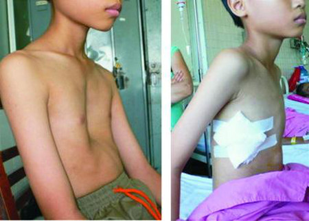 Picture 2 of Congenital chest concave and health consequences