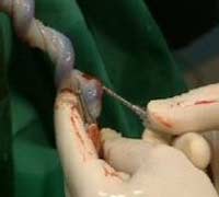 Picture 1 of Create bone from umbilical cord blood