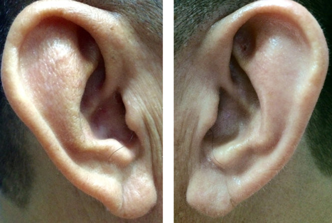 Picture 2 of Crossbones in the earlobe warn of cardiovascular disease