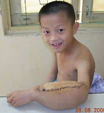 Picture 2 of Cut off tumor nodules 4 kg on a ten year old boy