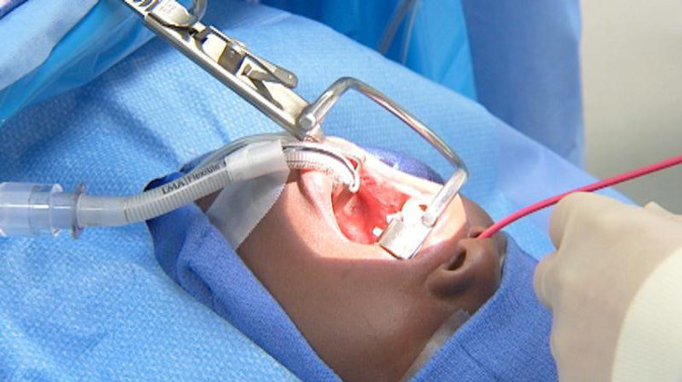 Picture 1 of Dangerous complications can occur when tonsils are removed