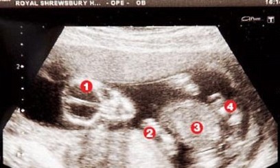 Picture 2 of Decode the phenomenon of natural pregnancy