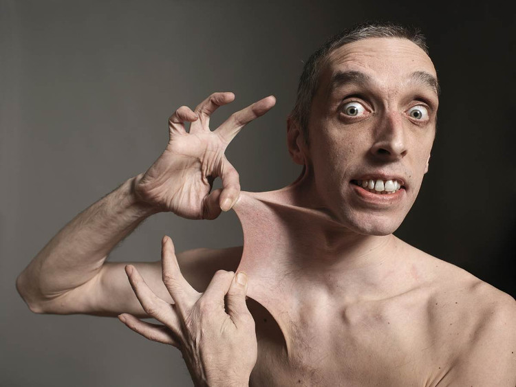 Picture 1 of Decode the rare 'elastic skin' disease in the world