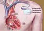 Picture 1 of Defibrillators are more effective for men than women