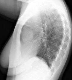 Picture 1 of Delta muscle atrophy has been around since the 1980s