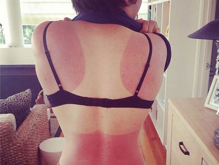 Picture 1 of Dermatologists recommend the 3 fastest ways to remove sunburns