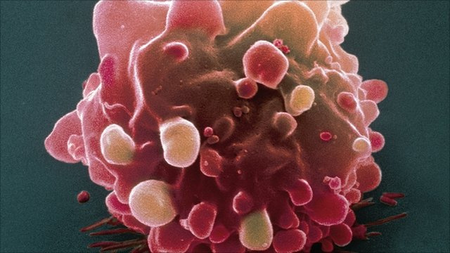 Picture 1 of Detected two culprit genes causing bowel cancer