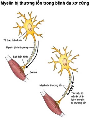 Picture 2 of Detecting 2 genes that cause multiple sclerosis