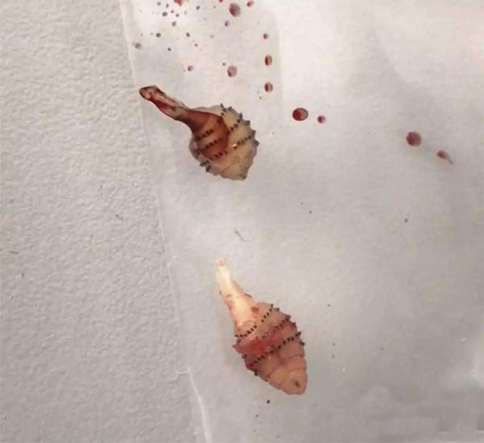 Picture 1 of Detecting maggots coming out of the leg after the tour