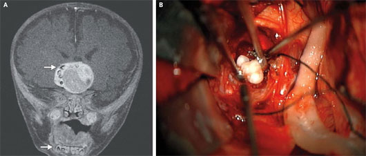 Picture 1 of Detecting teeth in newborn brains
