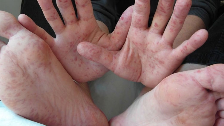 Picture 1 of Detecting the type of gene that causes hand, foot and mouth disease