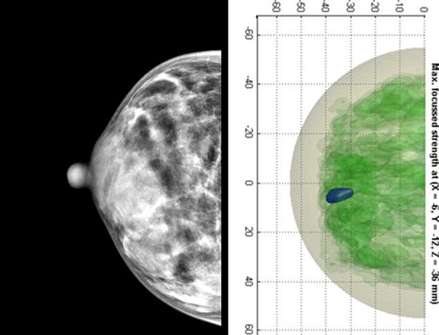Picture 3 of Detection of breast cancer using mine detection technology