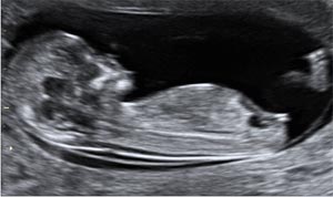 Picture 1 of Detection of Down syndrome when the fetus is only 11 to nearly 14 weeks old
