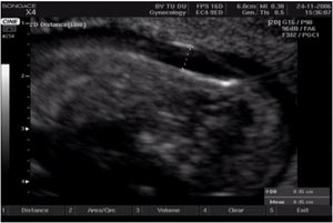 Picture 2 of Detection of Down syndrome when the fetus is only 11 to nearly 14 weeks old