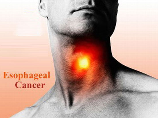 Picture 1 of Detection of gene variants causing esophageal cancer
