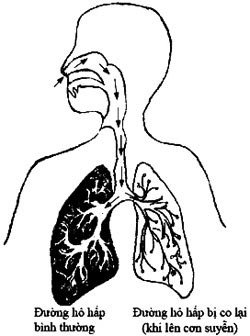 Picture 1 of Detection of genes involved in asthma in children