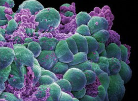 Picture 1 of Determining the gene causes breast cancer cells to spread