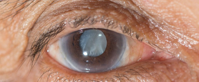Picture 1 of Develop drugs to help dissolve cataract