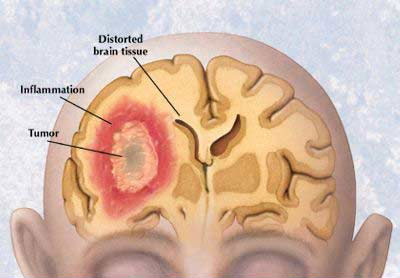 Picture 1 of Develop new technology for early detection of brain tumors
