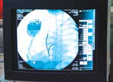 Picture 2 of Device ICD saves millions of people with heart disease