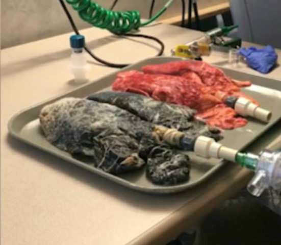 Picture 1 of Difference between lungs of healthy people and smokers 20 years