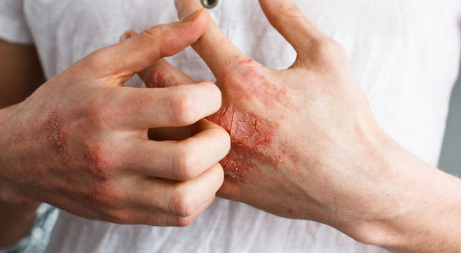 Picture 2 of Disaster comes from modern life named: Food allergy