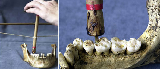 Picture 1 of Discover dental techniques in ancient times