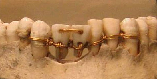Picture 2 of Discover dental techniques in ancient times