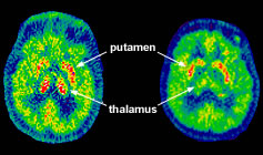 Picture 2 of Discovered two types of genes that treat Parkinson's disease