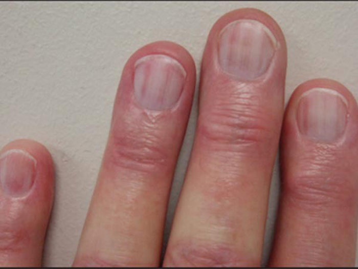 Picture 1 of Disease signs appear on nails
