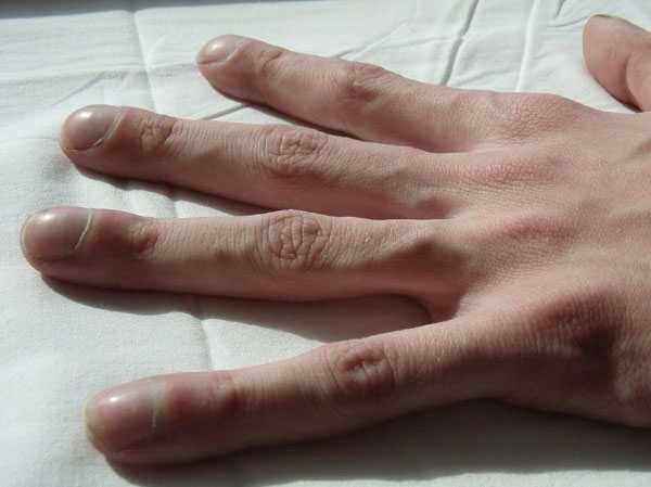 Picture 2 of Disease signs appear on nails