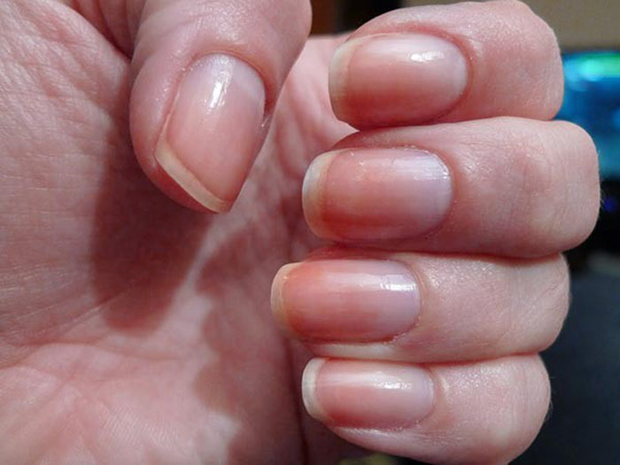 Picture 4 of Disease signs appear on nails
