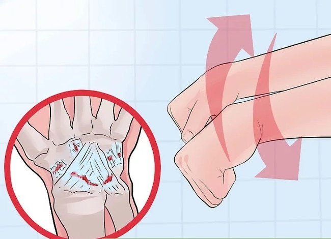 Picture 1 of Distinguish between wrist sprains and wrist fractures