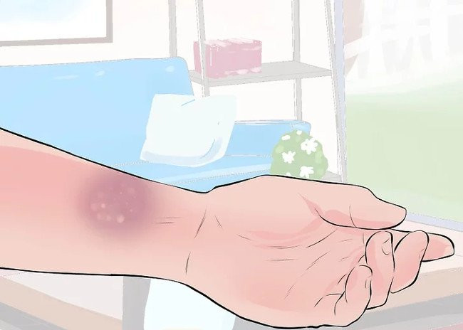Picture 4 of Distinguish between wrist sprains and wrist fractures