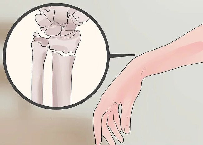 Picture 6 of Distinguish between wrist sprains and wrist fractures
