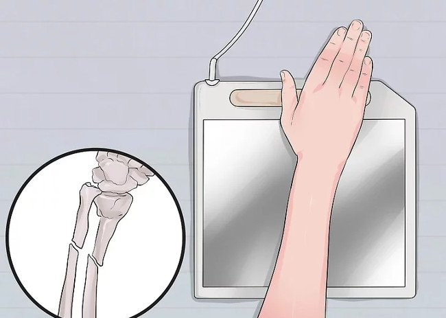 Picture 9 of Distinguish between wrist sprains and wrist fractures