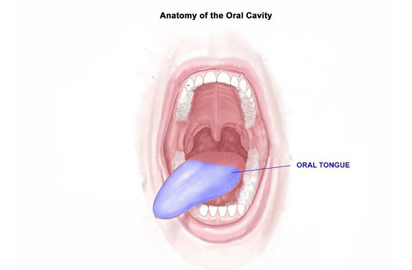 Picture 3 of Do not confuse tongue cancer and mouth heat