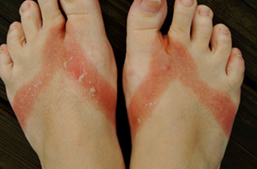 Picture 4 of Do not wear flip flops often