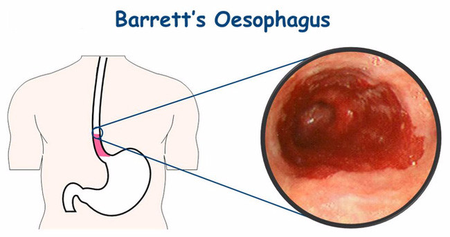 Picture 2 of Drinking too hot over 65 degrees C can cause esophageal cancer