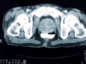 Picture 1 of Early detection of blood cancer cells by sound